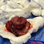 Surgical removal of jaw due to carcinoma under tongue