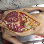 Chinese woman with severed carotid artery