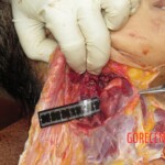Chinese woman with severed carotid artery