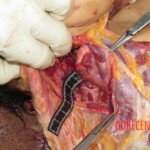 Chinese woman with severed carotid artery