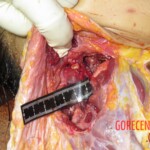 Chinese woman with severed carotid artery