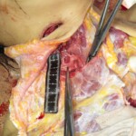 Chinese woman with severed carotid artery