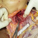 Chinese woman with severed carotid artery