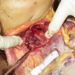 Chinese woman with severed carotid artery