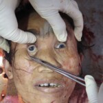 Chinese woman with severed carotid artery