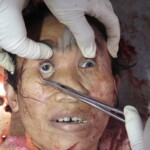 Chinese woman with severed carotid artery