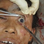 Chinese woman with severed carotid artery
