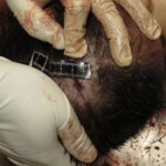 Chinese woman with severed carotid artery