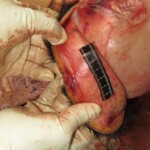 Chinese woman with severed carotid artery