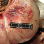 Chinese woman with severed carotid artery
