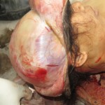 Chinese woman with severed carotid artery