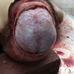 Chinese woman with severed carotid artery