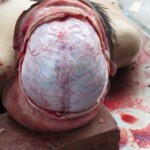 Chinese woman with severed carotid artery