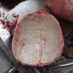 Chinese woman with severed carotid artery