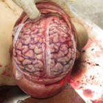 Chinese woman with severed carotid artery