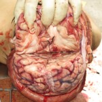 Chinese woman with severed carotid artery
