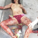 Chinese woman with severed carotid artery