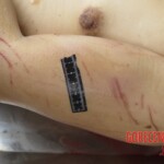 Chinese woman with severed carotid artery