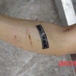 Chinese woman with severed carotid artery