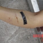 Chinese woman with severed carotid artery