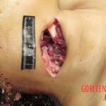 Chinese woman with severed carotid artery