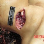 Chinese woman with severed carotid artery