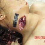 Chinese woman with severed carotid artery