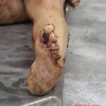 Chinese woman with severed carotid artery