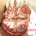 Chinese woman with severed carotid artery