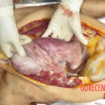 Chinese woman with severed carotid artery