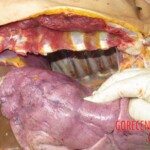 Chinese woman with severed carotid artery