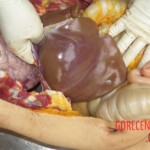 Chinese woman with severed carotid artery