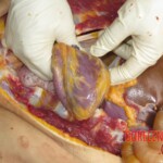Chinese woman with severed carotid artery