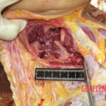 Chinese woman with severed carotid artery