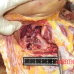 Chinese woman with severed carotid artery