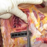 Chinese woman with severed carotid artery