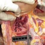 Chinese woman with severed carotid artery