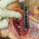 Chinese woman with severed carotid artery