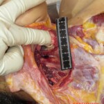 Chinese woman with severed carotid artery