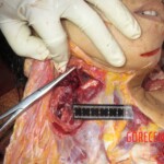 Chinese woman with severed carotid artery