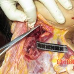 Chinese woman with severed carotid artery