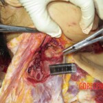 Chinese woman with severed carotid artery