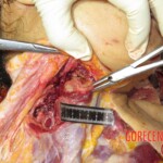 Chinese woman with severed carotid artery