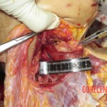 Chinese woman with severed carotid artery