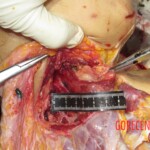 Chinese woman with severed carotid artery