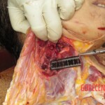 Chinese woman with severed carotid artery