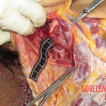 Chinese woman with severed carotid artery