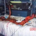 Radiation burns of nuclear power plant worker