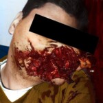Suicide by firecracker in mouth