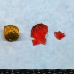 Suicide by firecracker in mouth